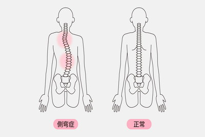 側弯症の主な症状と原因とは | 東京にある大塚整体治療院