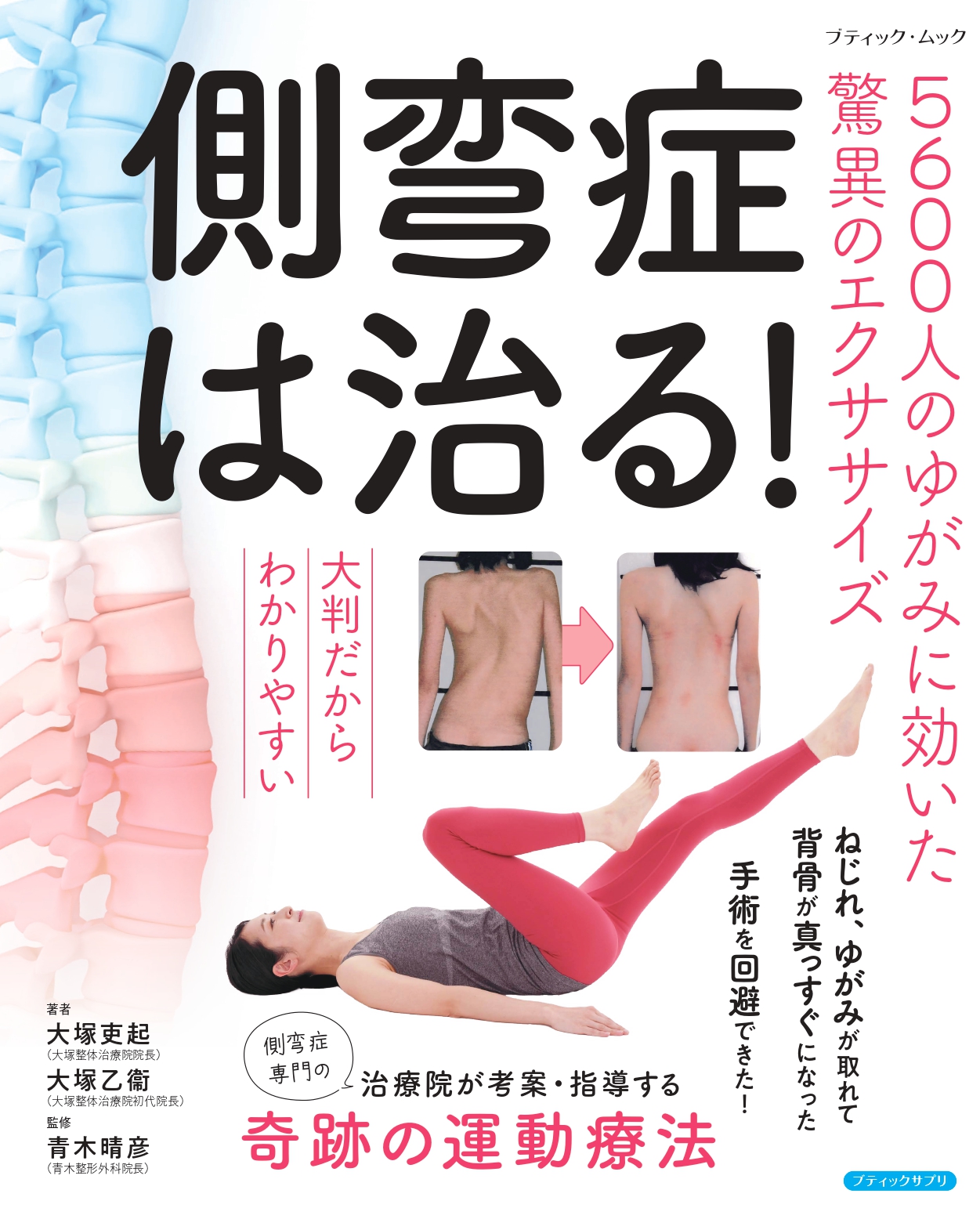 側弯症は治るの出版についてと装具の寿命について 画像